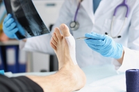 What Is Ankle Arthrodesis?