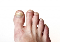 What to Do About Toenail Fungus