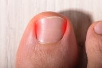 Facts About Ingrown Toenails