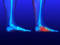 Flat Feet May Cause Foot Pain
