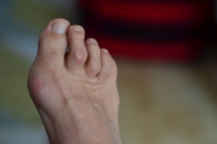 Definition and Facts About Hammertoe
