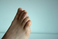 What to Do About Corns on the Feet