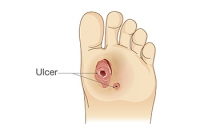 Managing Diabetic Foot Ulcers