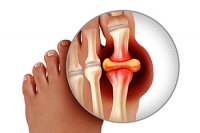 What You Eat Can Cause Gout